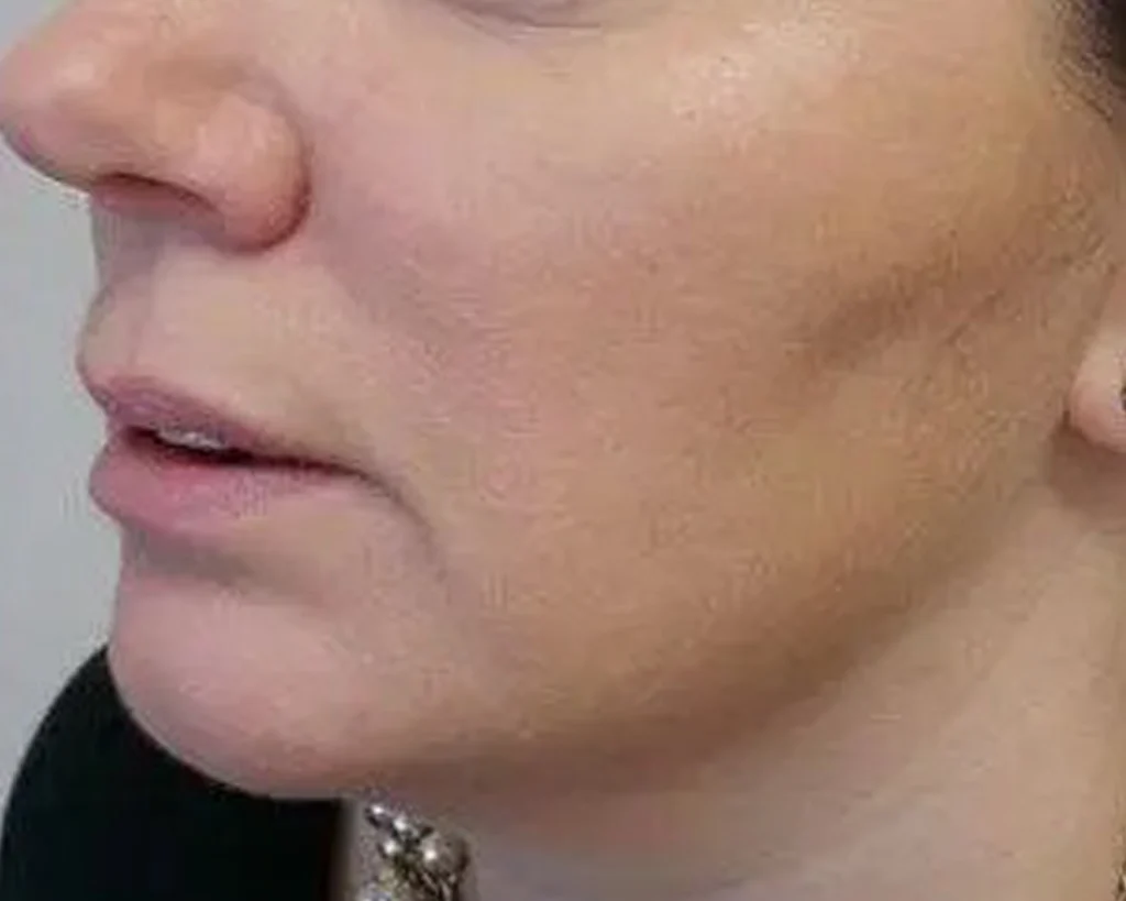 Monica Assis depois